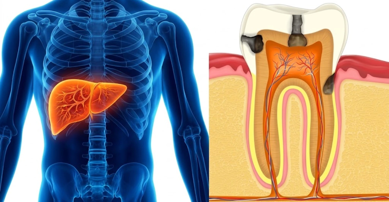 Primary Biliary Cholangitis and Tooth Decay 1